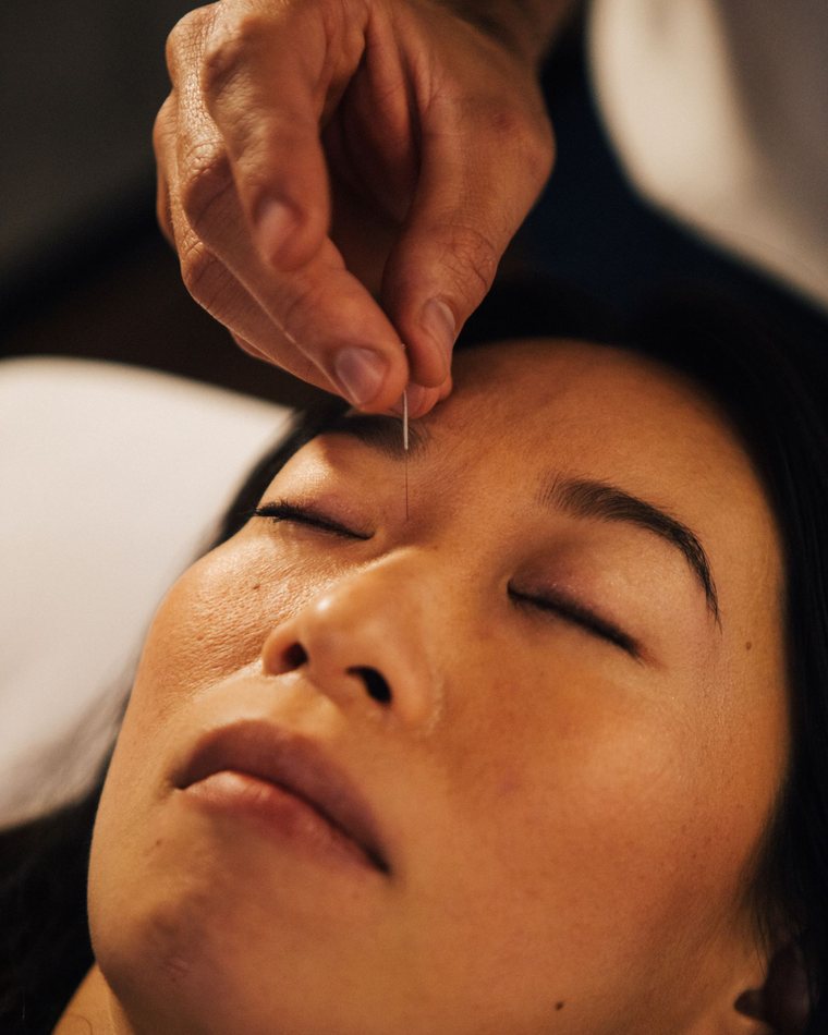 Facial acupuncture at Gateway Acupuncture