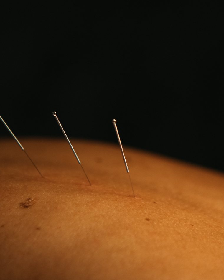 Pulse-guided needling at Gateway Acupuncture
